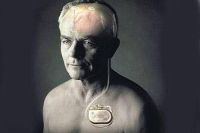 【健康解碼】起搏器真的能治好帕金森病嗎？